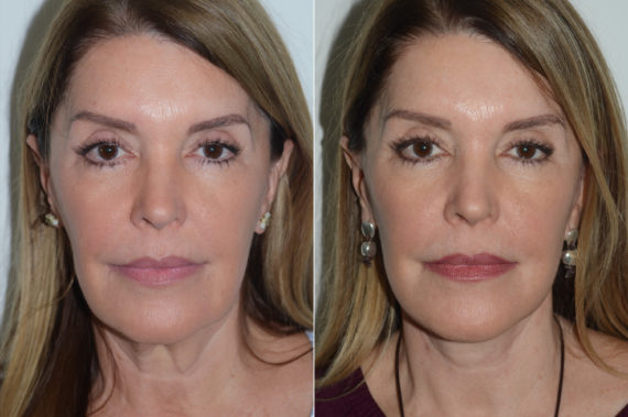 Deep Plane Facelift Before and After Photos in Miami, FL, Patient 19635