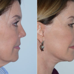 Deep Plane Facelift Before and After Photos in Miami, FL, Patient 19635