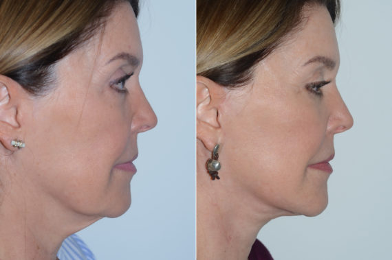 Deep Plane Facelift Before and After Photos in Miami, FL, Patient 19635