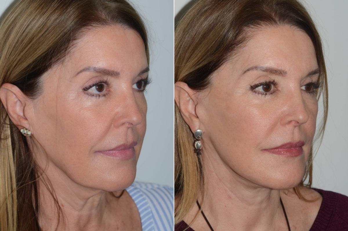 Deep Plane Facelift Before and After Photos in Miami, FL, Patient 19635