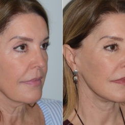 Deep Plane Facelift Before and After Photos in Miami, FL, Patient 19635