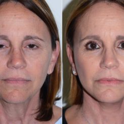 Deep Plane Facelift Before and After Photos in Miami, FL, Patient 17049