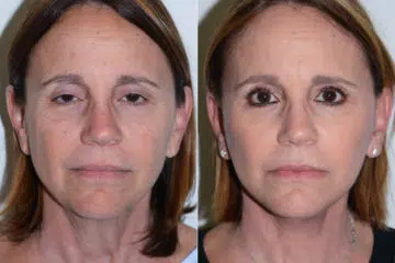 Deep Plane Facelift Before and After Photos in Miami, FL, Patient 17049