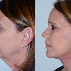 Deep Plane Facelift Before and After Photos in Miami, FL, Patient 17049