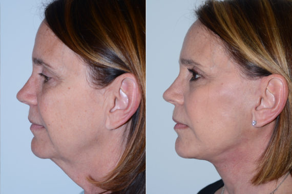 Deep Plane Facelift Before and After Photos in Miami, FL, Patient 17049