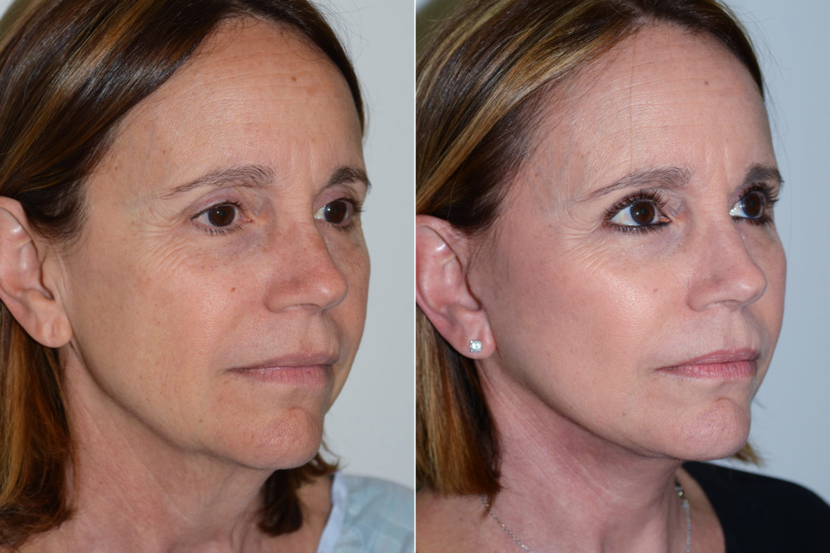 Deep Plane Facelift Before and After Photos in Miami, FL, Patient 17049