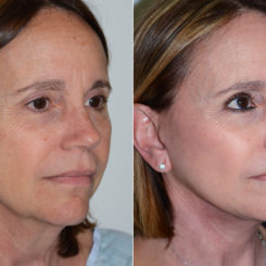 Deep Plane Facelift Before and After Photos in Miami, FL, Patient 17049