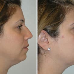 Chin Augmentation Before and After Photos in Miami, FL, Patient 15797