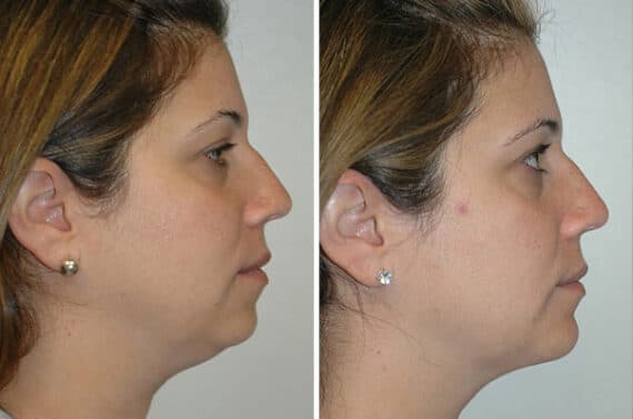 Chin Augmentation Before and After Photos in Miami, FL, Patient 15797