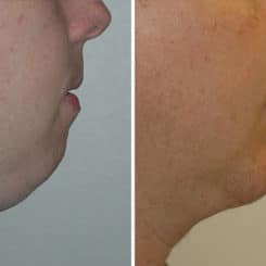 Chin Augmentation Before and After Photos in Miami, FL, Patient 15800