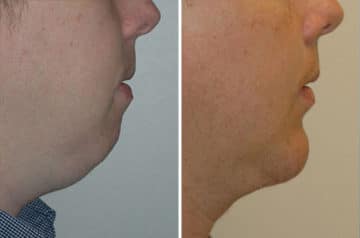 Chin Augmentation Before and After Photos in Miami, FL, Patient 15800