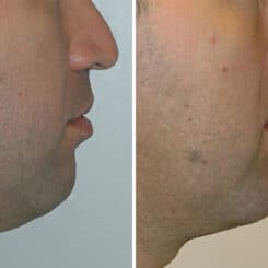 Chin Augmentation Before and After Photos in Miami, FL, Patient 15803