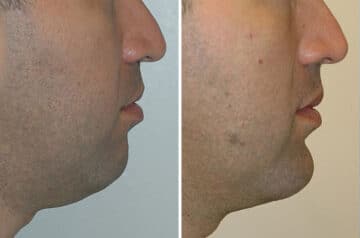 Chin Augmentation Before and After Photos in Miami, FL, Patient 15803