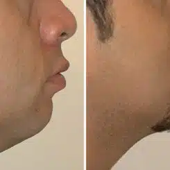 Chin Augmentation Before and After Photos in Miami, FL, Patient 15806