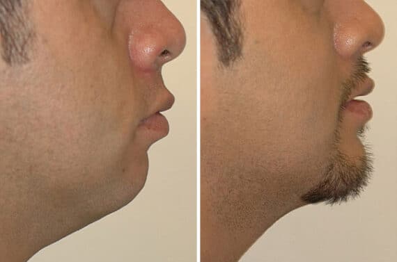 Chin Augmentation Before and After Photos in Miami, FL, Patient 15806