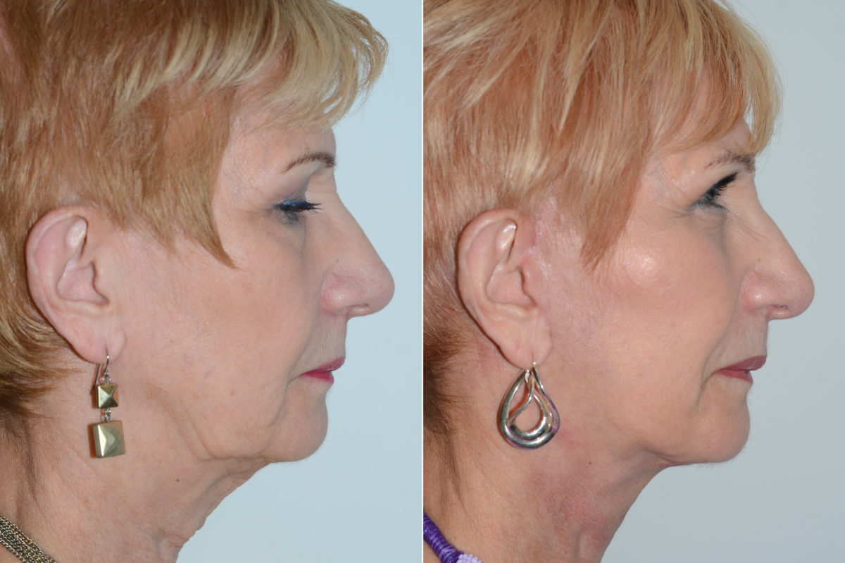 Deep Plane Facelift Before and After Photos in Miami, FL, Patient 16993