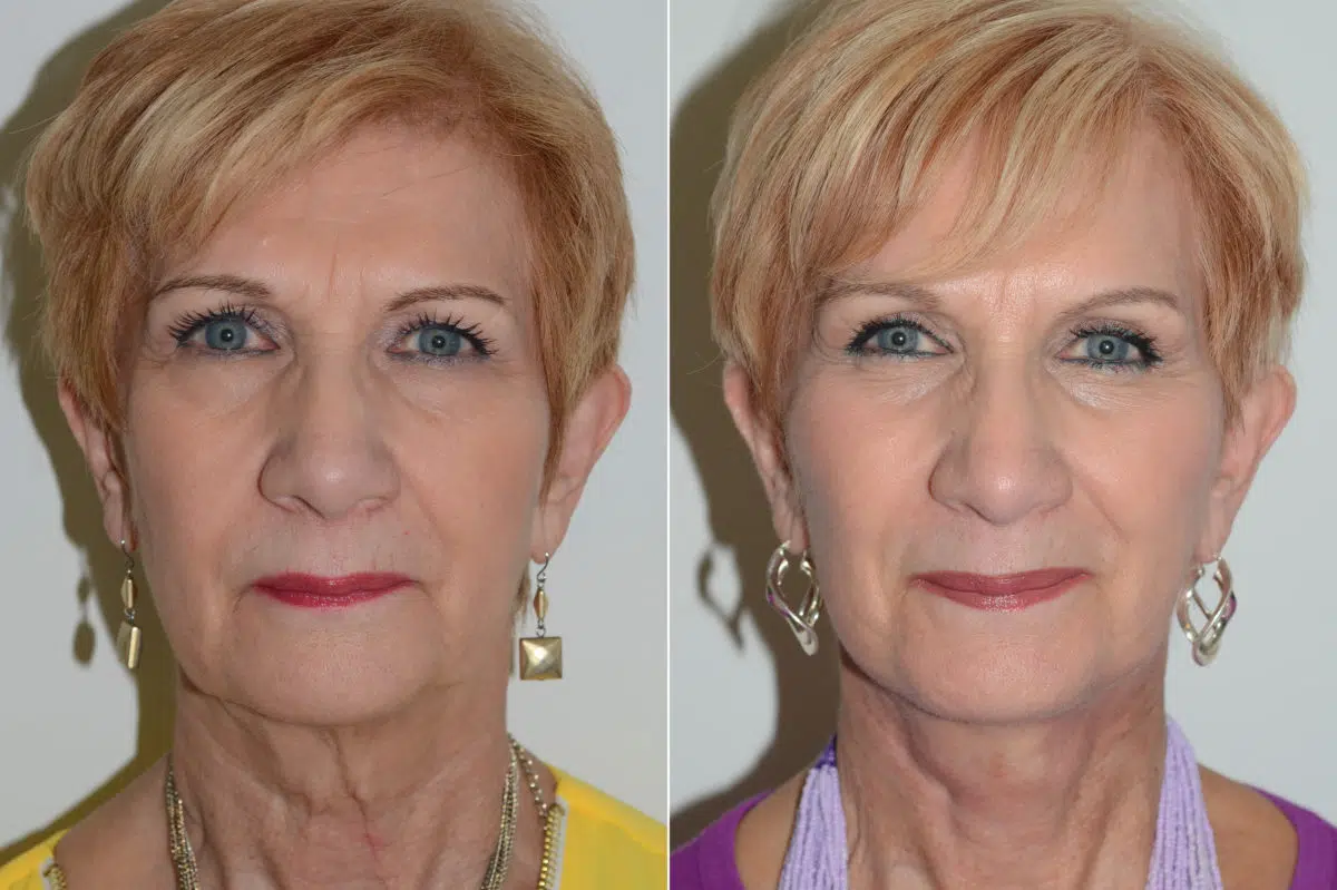 Deep Plane Facelift Before and After Photos in Miami, FL, Patient 16993