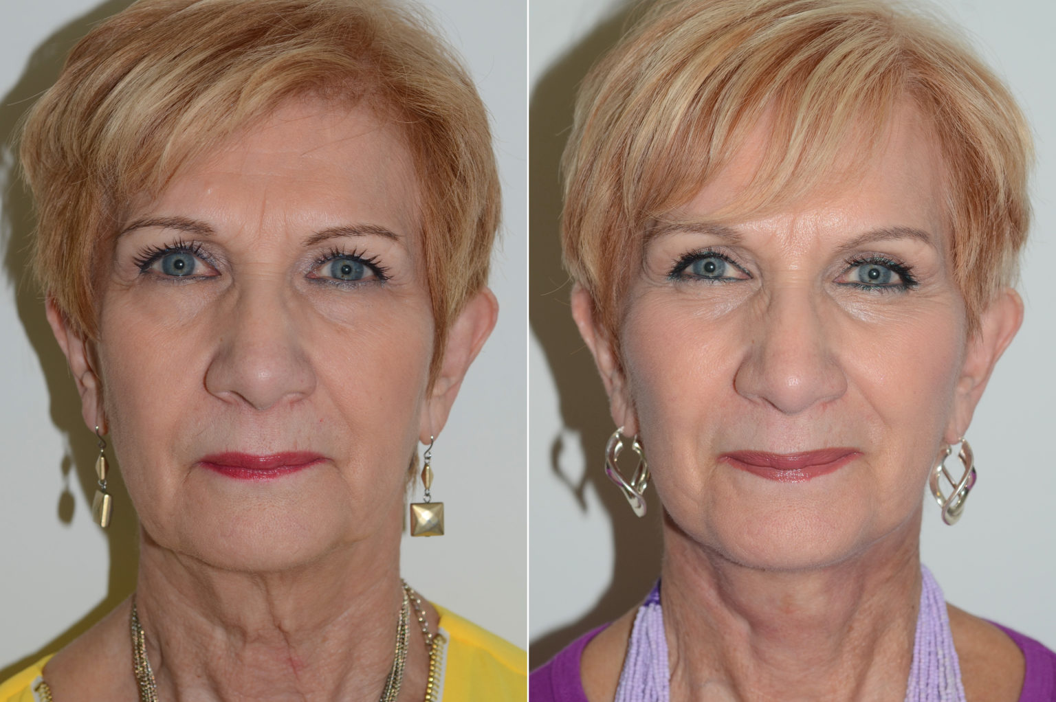 See Future Facelift Results Tools Tips see-future-facelift-results-tools-tips