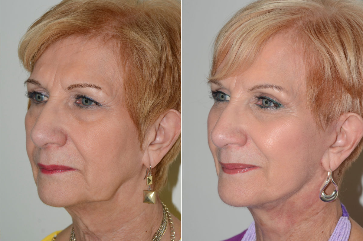 Deep Plane Facelift Before and After Photos in Miami, FL, Patient 16993