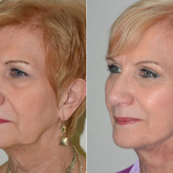 Deep Plane Facelift Before and After Photos in Miami, FL, Patient 16993