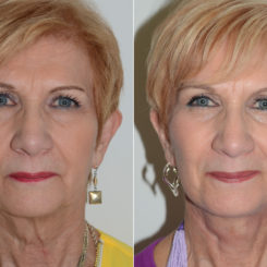 Deep Plane Facelift Before and After Photos in Miami, FL, Patient 16993