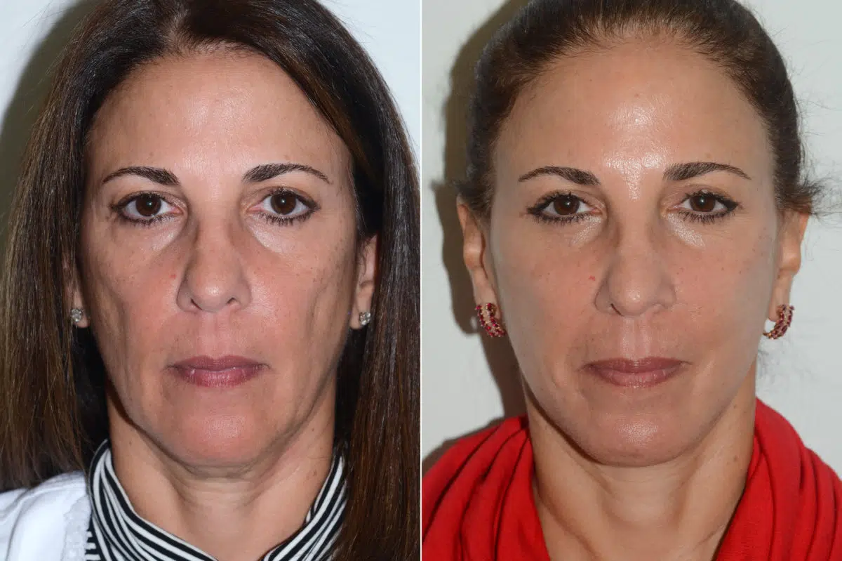 Chin Augmentation Before and After Photos in Miami, FL, Patient 20155