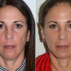 Chin Augmentation Before and After Photos in Miami, FL, Patient 20155