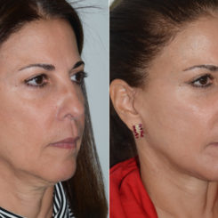 Chin Augmentation Before and After Photos in Miami, FL, Patient 20155