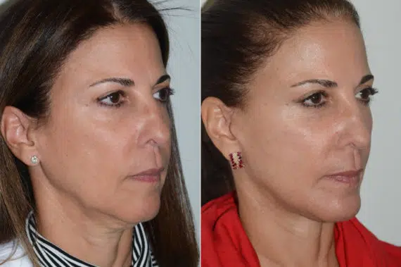 Deep Plane Facelift Before and After Photos in Miami, FL, Patient 20155