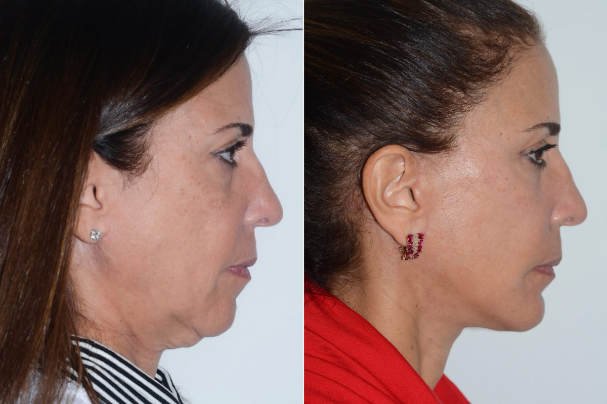 Chin Augmentation Before and After Photos in Miami, FL, Patient 20155