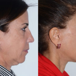 Chin Augmentation Before and After Photos in Miami, FL, Patient 20155