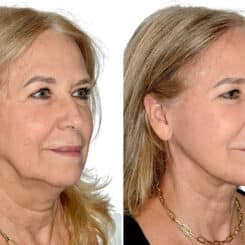 Deep Plane Facelift Before and After Photos in Miami, FL, Patient 22412