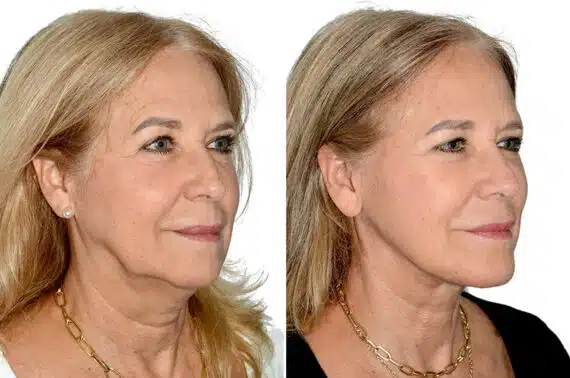 Deep Plane Facelift Before and After Photos in Miami, FL, Patient 22412