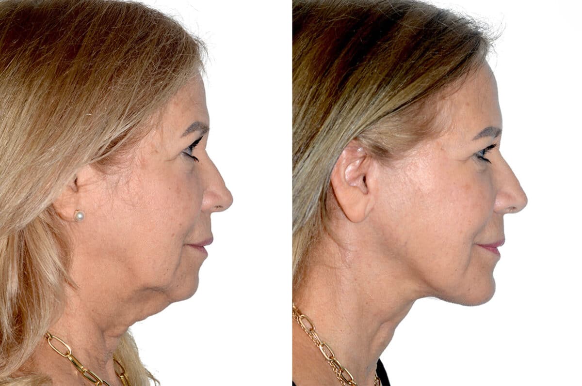 Deep Plane Facelift Before and After Photos in Miami, FL, Patient 22412