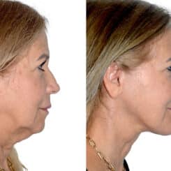 Deep Plane Facelift Before and After Photos in Miami, FL, Patient 22412