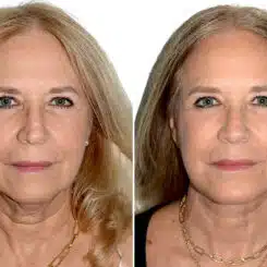 Deep Plane Facelift Before and After Photos in Miami, FL, Patient 22412