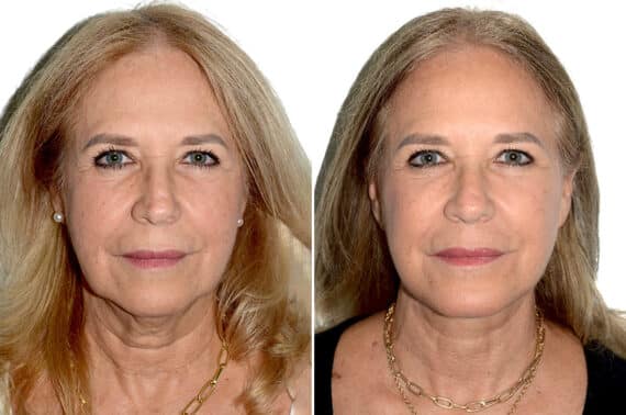 Deep Plane Facelift Before and After Photos in Miami, FL, Patient 22412