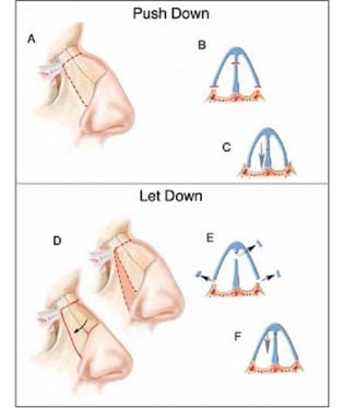 Preservation rhinoplasty refers to a series of different techniques with the main goal to preserve the cartilaginous framework of the nose.