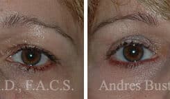 Blepharoplasty (eyelids) Before and After Photos in Miami, FL, Patient 15779