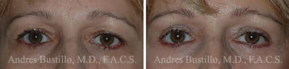 Blepharoplasty (eyelids) Before and After Photos in Miami, FL, Patient 15779