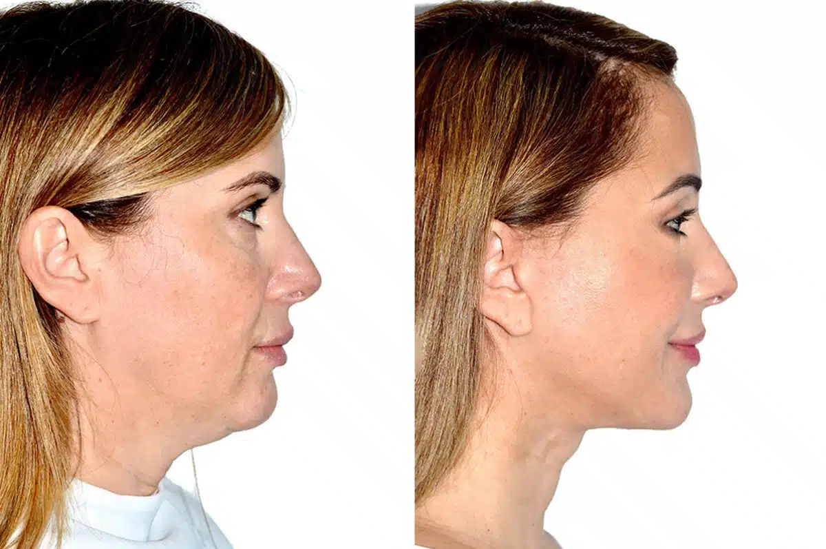 Deep Plane Facelift Before and After Photos in Miami, FL, Patient 21760