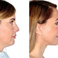Deep Plane Facelift Before and After Photos in Miami, FL, Patient 21760