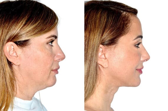 Deep Plane Facelift Before and After Photos in Miami, FL, Patient 21760