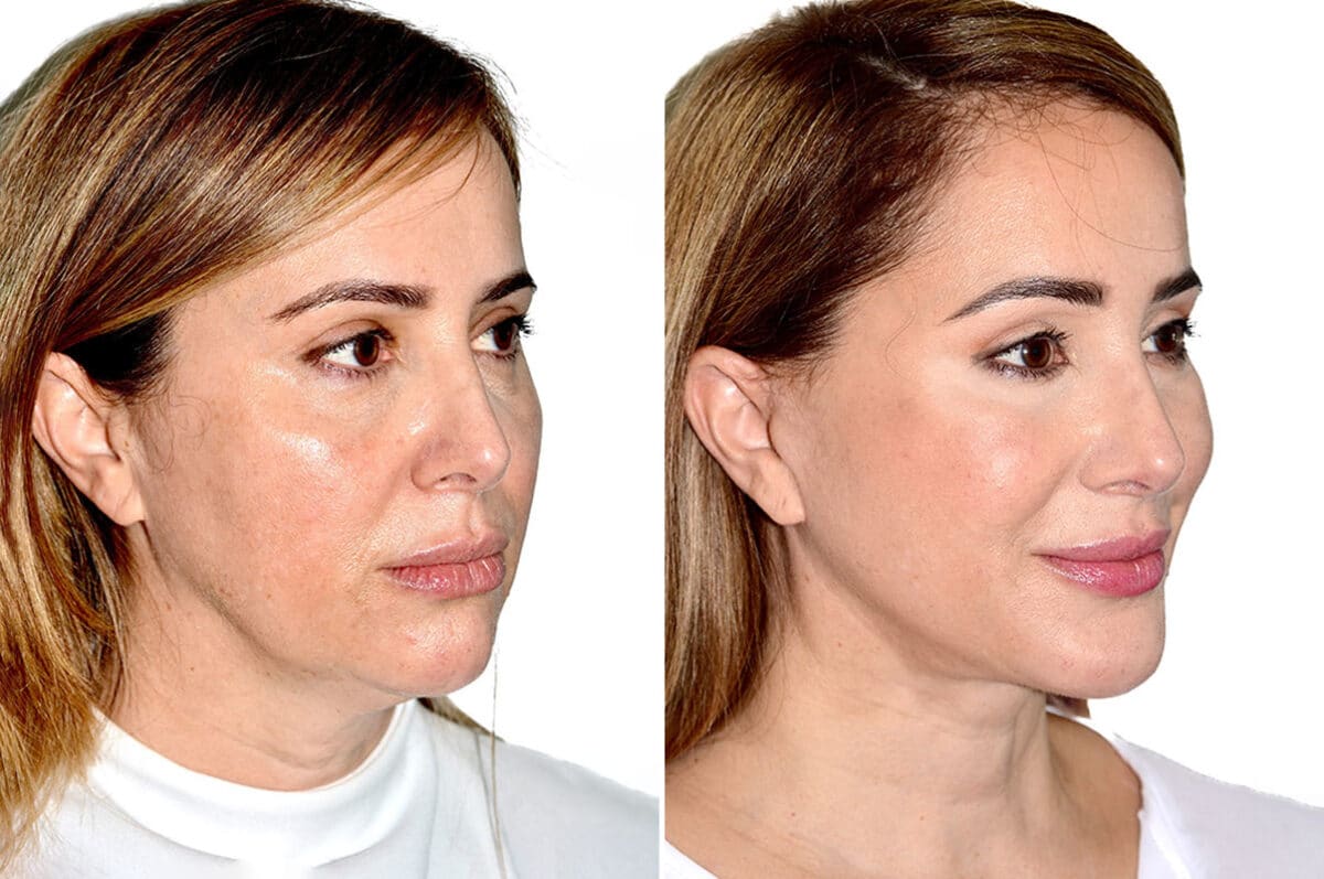 Deep Plane Facelift Before and After Photos in Miami, FL, Patient 21760