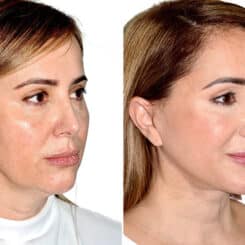 Deep Plane Facelift Before and After Photos in Miami, FL, Patient 21760
