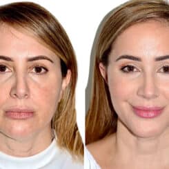 Deep Plane Facelift Before and After Photos in Miami, FL, Patient 21760