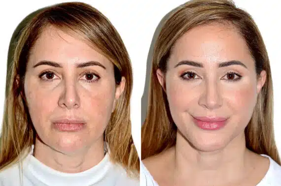 Deep Plane Facelift Before and After Photos in Miami, FL