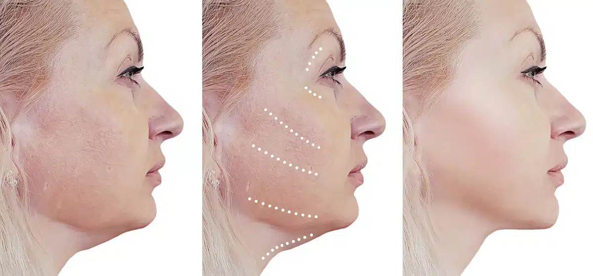 Traditional facelift overview of the entire procedure in Miami, FL.