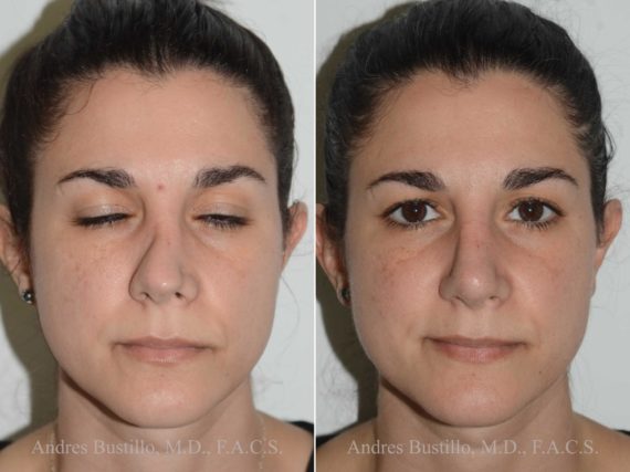 Tipo de procedimientos quirúrgicos que afectan el costo de la rinoplastia en Miami, como la rinoplastia de revisión.