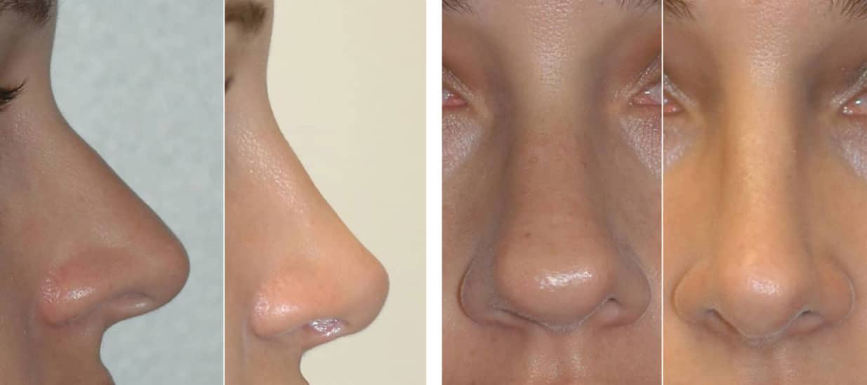 Ultrasonic Rhinoplasty and Preservation Rhinoplasty Procedure.